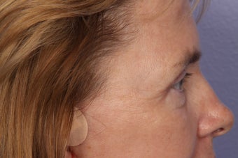 Eyelid Surgery after 324138