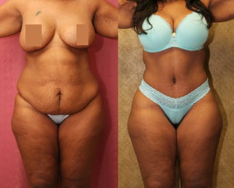 tummy tuck before 304705