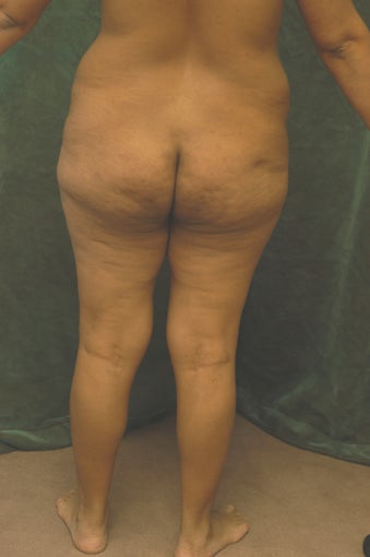 Women's Buttocks Augmentation 518137
