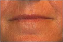 Active & Deep FX ~ CO2 Laser Skin Resurfacing before 130744