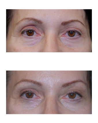 Lateral Brow Lift before 349203