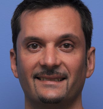Otoplasty after 361344