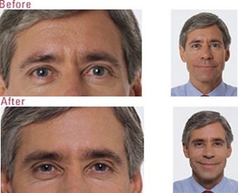 Botox for Frown Lines before 6319