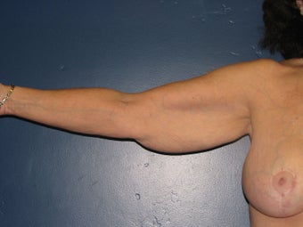 Brachioplasty before 575818