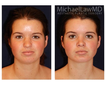Chin Liposuction before 395814