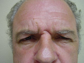 Botox 531096