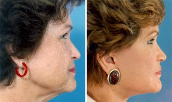 Facelift before 643019