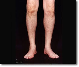 Calf Implant after 566013
