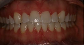 Orthodontic treatment without extraction of teeth 546583
