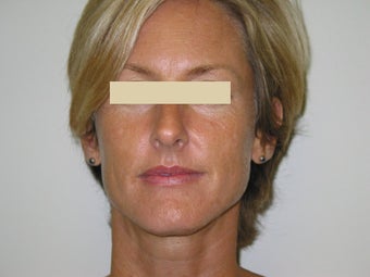 Advamta Lip Augmentation before 147387