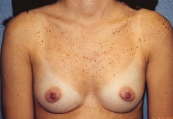 Breast Augmentation before 266781