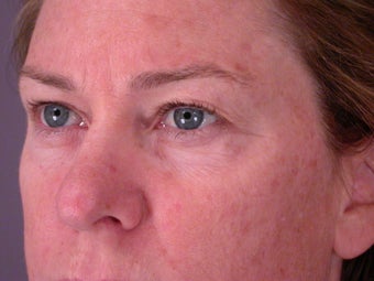 Eyelid Surgery before 306448