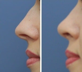 Rhinoplasty before 555764
