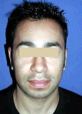 Otoplasty (Ear Surgery) after 146594
