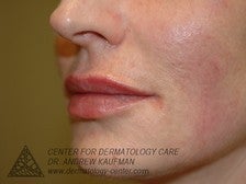 Juvederm Injection to Augment Lip Line after 315096