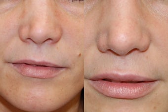 Non-Surgical Rhinoplasty and Lip Augmentation with Silikon-1000 before 136320
