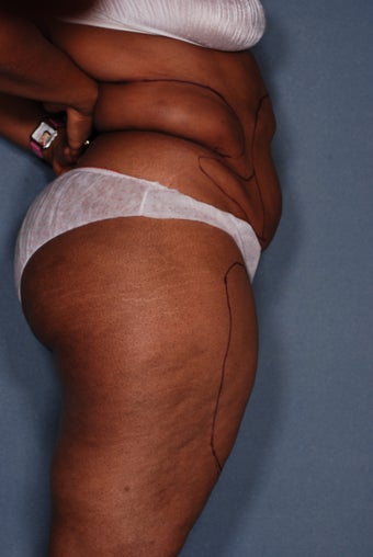 Wrap around Abs before 346572