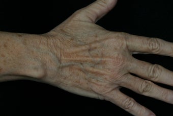 Dual Fraxel Laser before 309246