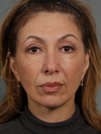 Sculptra after 269571
