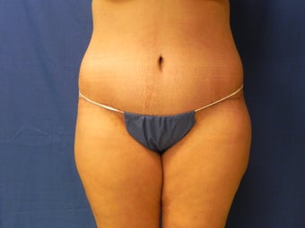 Body Lift after 460718