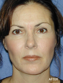 Cheek Impant Surgery after 328073