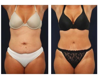 Tummy Tuck or Abdominoplasty before 283158