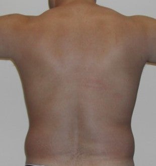 Liposuction love handles before 203477