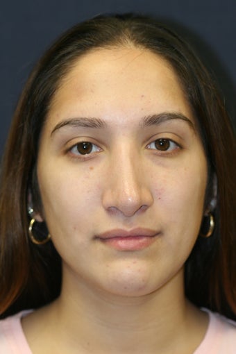 Rhinoplasty and Septoplasty after 527291