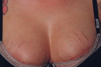 Stretch Mark Removal on the Breasts Before and after Laser before 448607