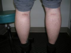Calf Implants after 258997