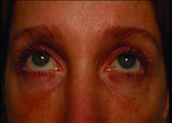 Radiesse under the eyes after 349881