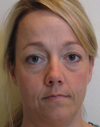 Dermal Filler before 601420