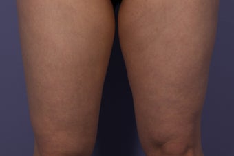 CoolSculpting Inner Thighs before 429659