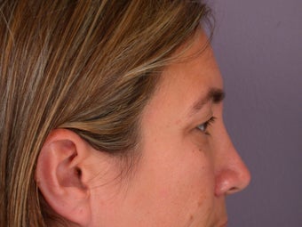 Eyelid Surgery before 306462