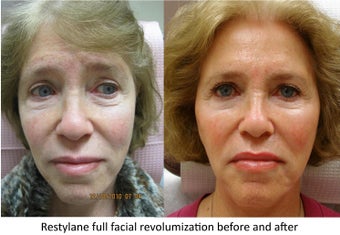 Restylane full facial rejuvenation before 390170