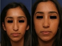 Rhinoplasty after 143650