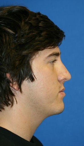 Rhinoplasty after 223240