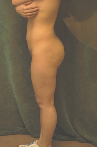 Women's Buttocks Augmentation before 518153