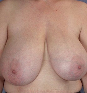 Breast Reduction before 285318