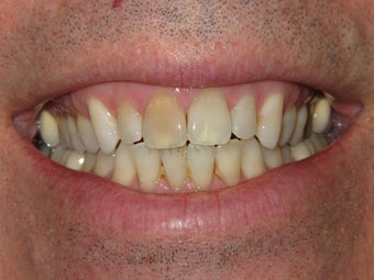 Whitening with walking bleach before 293325
