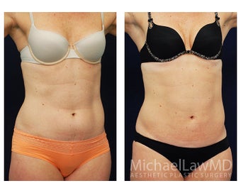 Liposuction after 495040