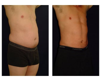 Liposuction before 286835