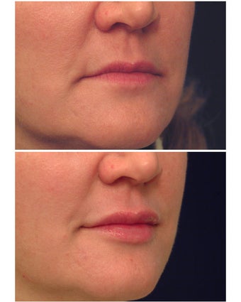 Injectable Filler before 149358