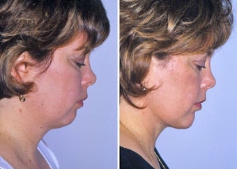 Liposuction of neck and chin augmentation after 332849