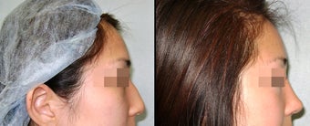 Rhinoplasty before 650762