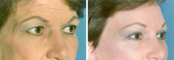 Forehead Lift before 652137