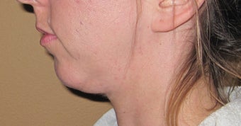 liposuction of double chin before 270057