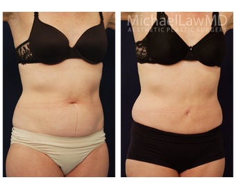 Liposuction after 495519