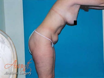 Vaser Lipo - Abdomen before 376424
