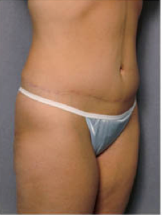 Tummy Tuck 428194